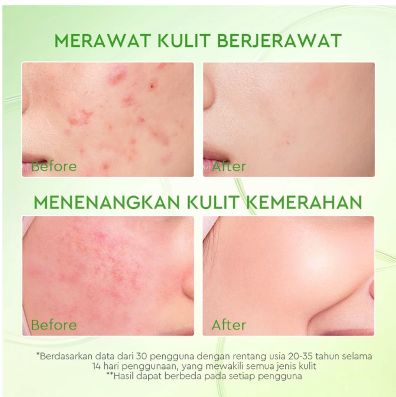 Glad2Glow Kiwi 3D Acid Acne Moisturizer